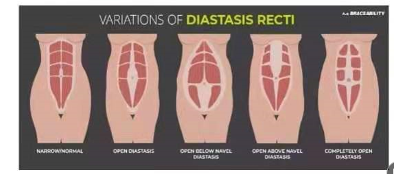 腹直肌分離如何分類？腹直肌分離修復