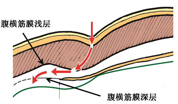 產(chǎn)后腹直肌分離如何康復(fù)，腹直肌修復(fù)那點事