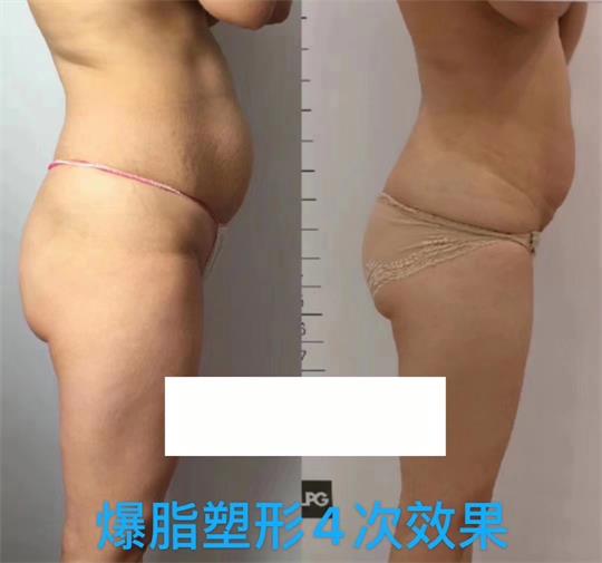 產(chǎn)后塑形美雕儀，生完孩子真的很難恢復(fù)身材？未必……