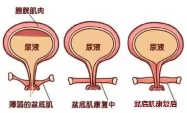 尿頻尿急尿不盡？或者可以試試盆底肌修復(fù)儀器電刺激