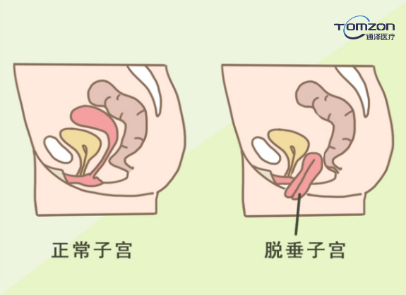 盆底肌修復(fù)儀器是如何促進(jìn)恢復(fù)的？