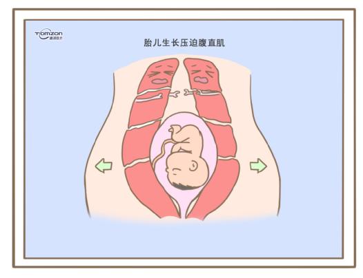 腹直肌分離可以使用盆底肌修復(fù)儀器嗎？