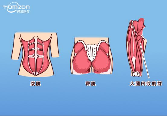 凱格爾運動該怎么做？盆底肌修復(fù)儀器效果會更好嗎？