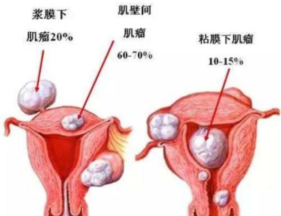 盆底肌修復