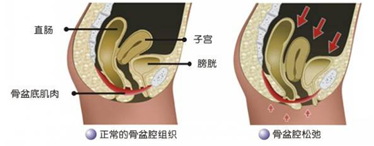 盆底肌修復(fù)