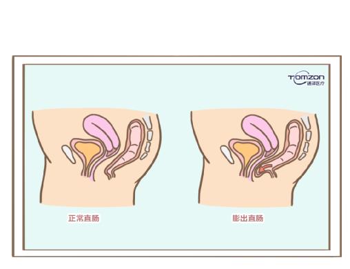 盆底肌修復(fù)儀器.jpg