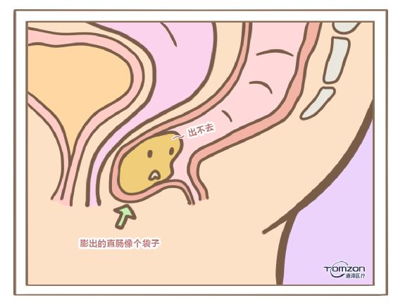 盆底康復(fù)治療儀